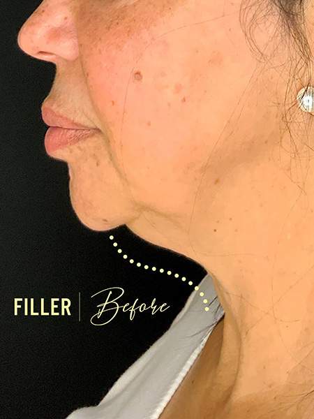 PLANTILLA AMIS B&A_FILLER_BEFORE_1