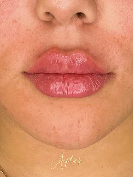 PLANTILLA AMIS B&A_LIP FILLER_AFTER_1