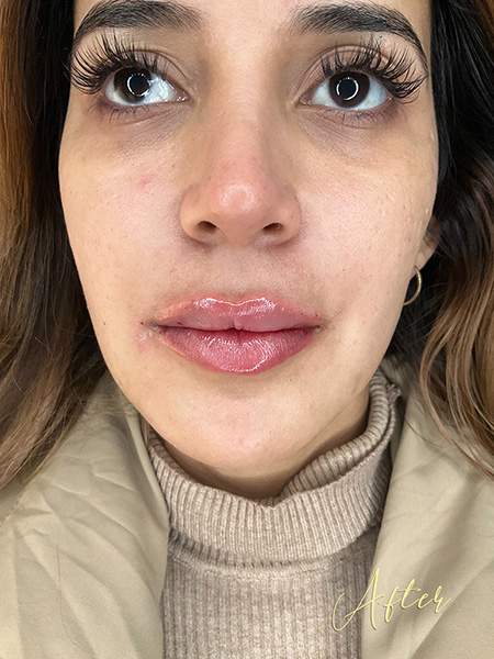 PLANTILLA AMIS B&A_LIPS FILLER_2AFTER