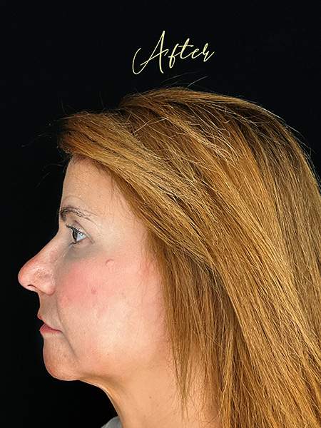 PLANTILLA AMIS B&A_nose filler_after2